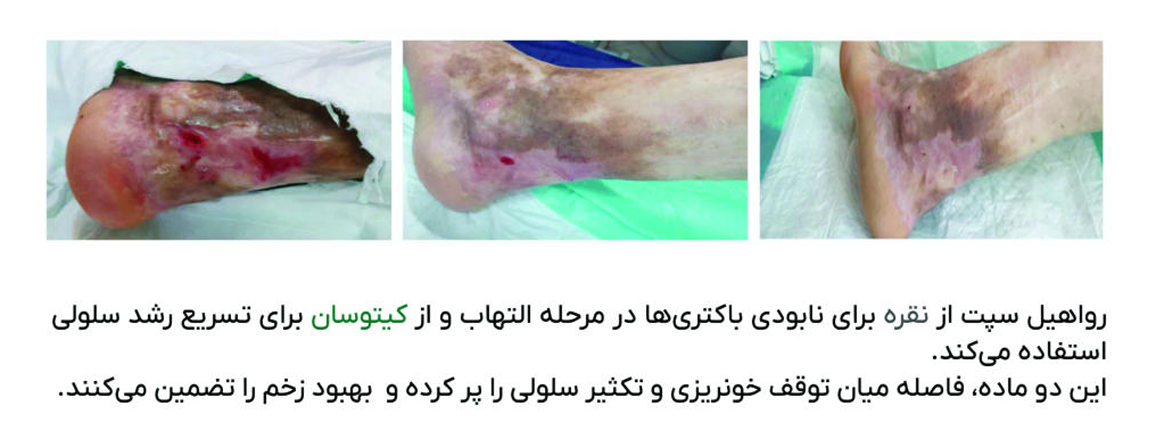 عملکرد بالینی اسپری ترمیم کننده و ضدعفونی کننده رواهیل سپت - حاوی نقره و کیتوسان